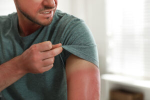 Man holding up his sleeve to show sunburned arm
