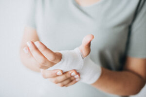 Picture of a woman with a gauze bandage covering a minor burn on her hand.